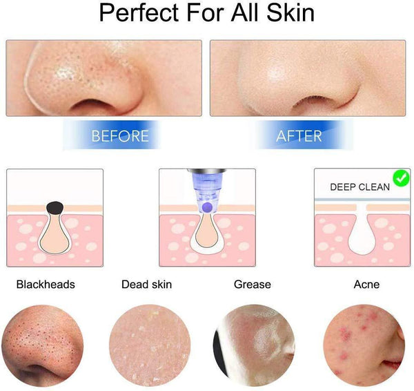 Diamond Acne Pore Vacuum Pro