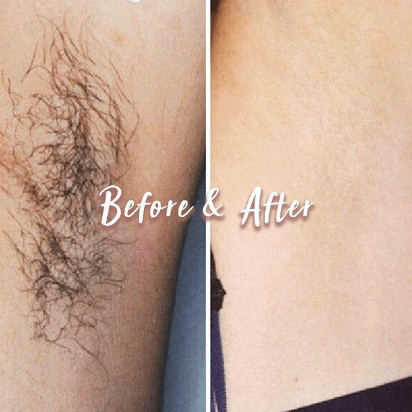 PERMANENT HAIR REMOVAL SPRAY